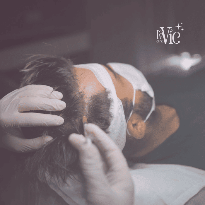 platelet-rich fibrin (PRF) for hair