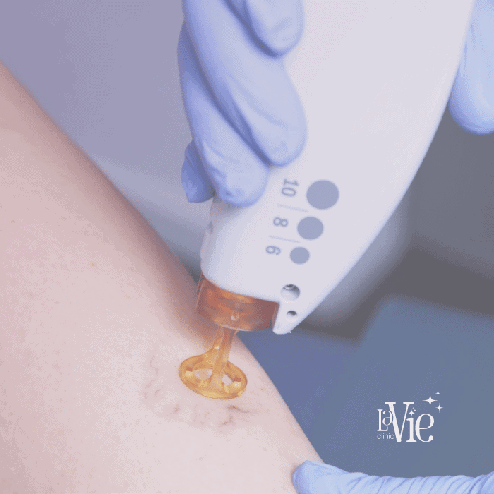 Spider Vein Removal